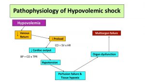 hypovolemic lifeflow